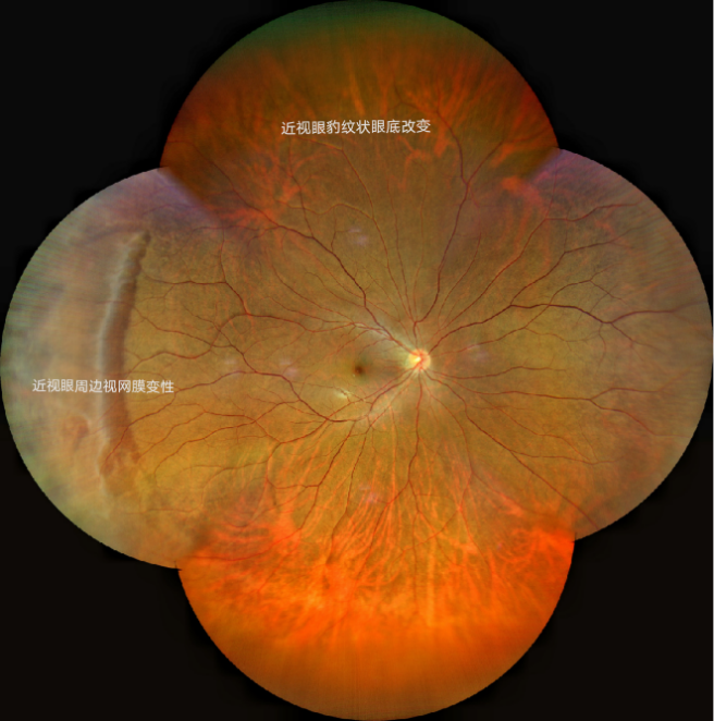 超广角眼底相机clarus 500拍摄到的近视眼眼底病变