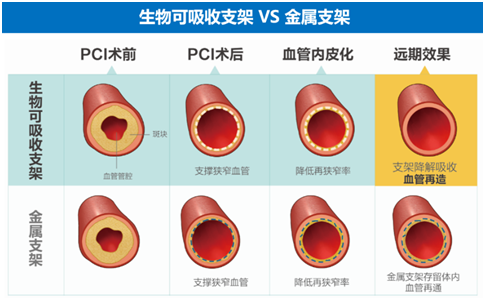 可降解支架为堵心冠心病患者点亮希望之光