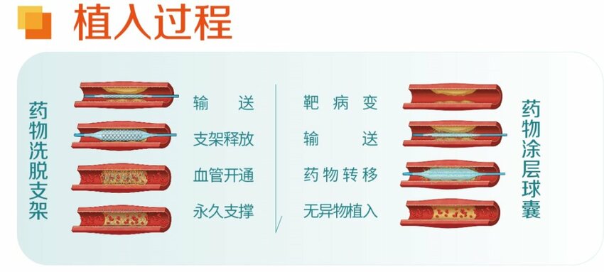 “介入无植入”专题研讨会成功举办 新技术为冠心病患者带来“心”福音