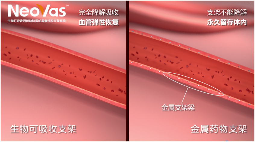 乐普可降解支架图片